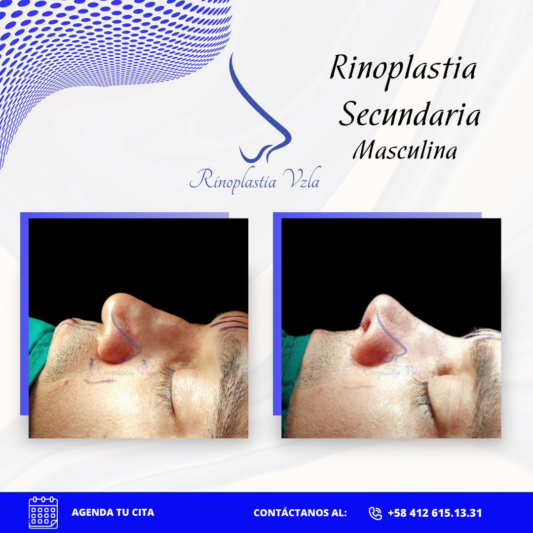 RINOPLASTIA-VENEZUELA